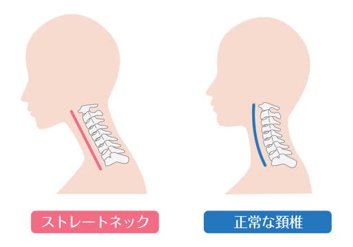 その腰痛はストレートネックが原因かも！？